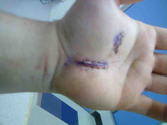 Name:  left side hand sugery.jpg
Views: 168
Size:  22.3 KB